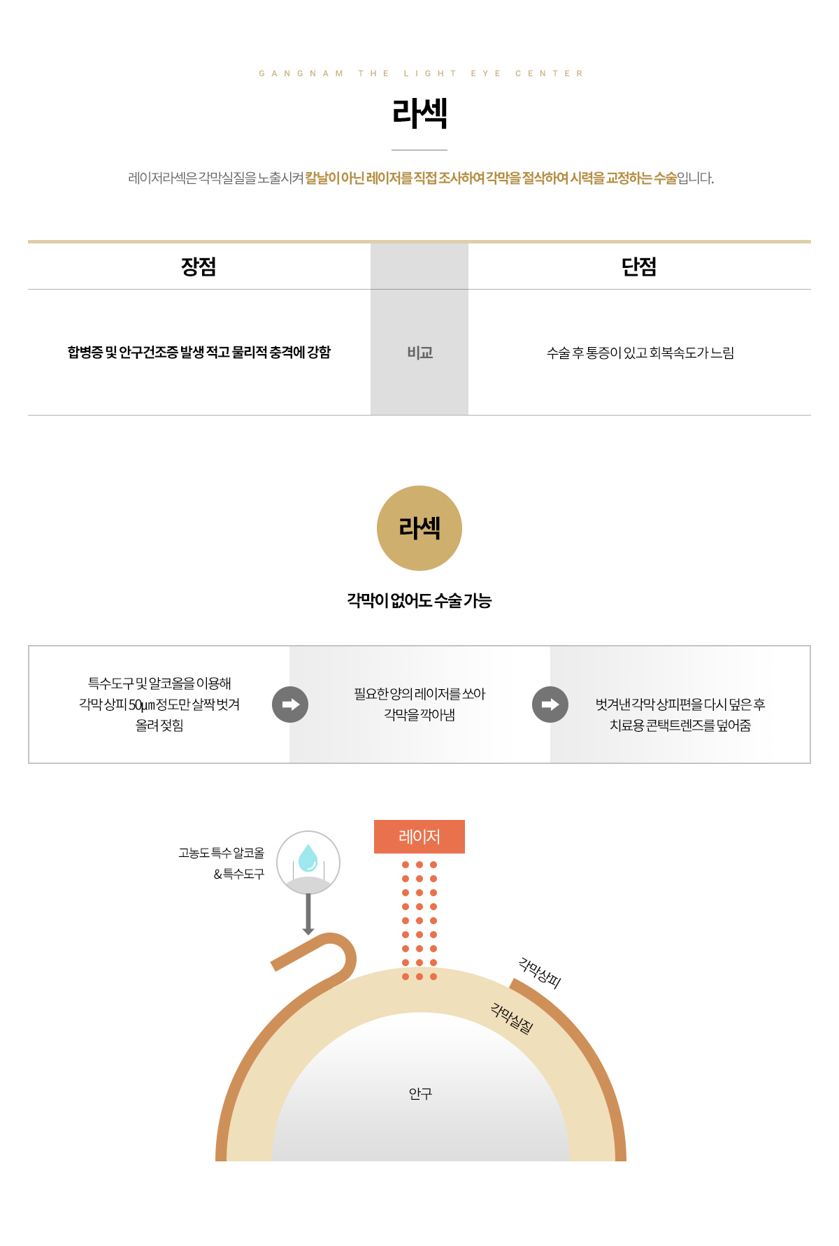 레이저 라섹