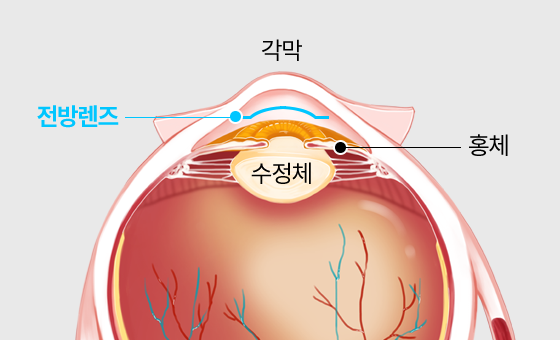 홍채 앞쪽에 렌즈를 고정하는 전방렌즈 삽입 위치